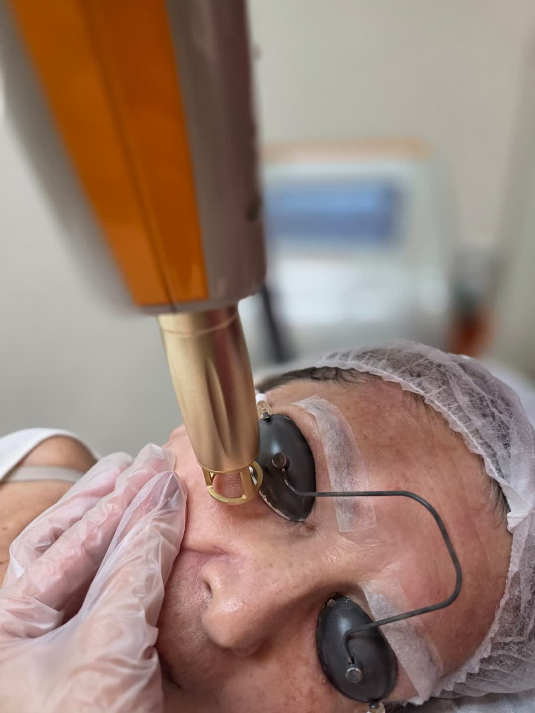 Rejuvenescimento com Luz Intensa Pulsada e Laser Erbium