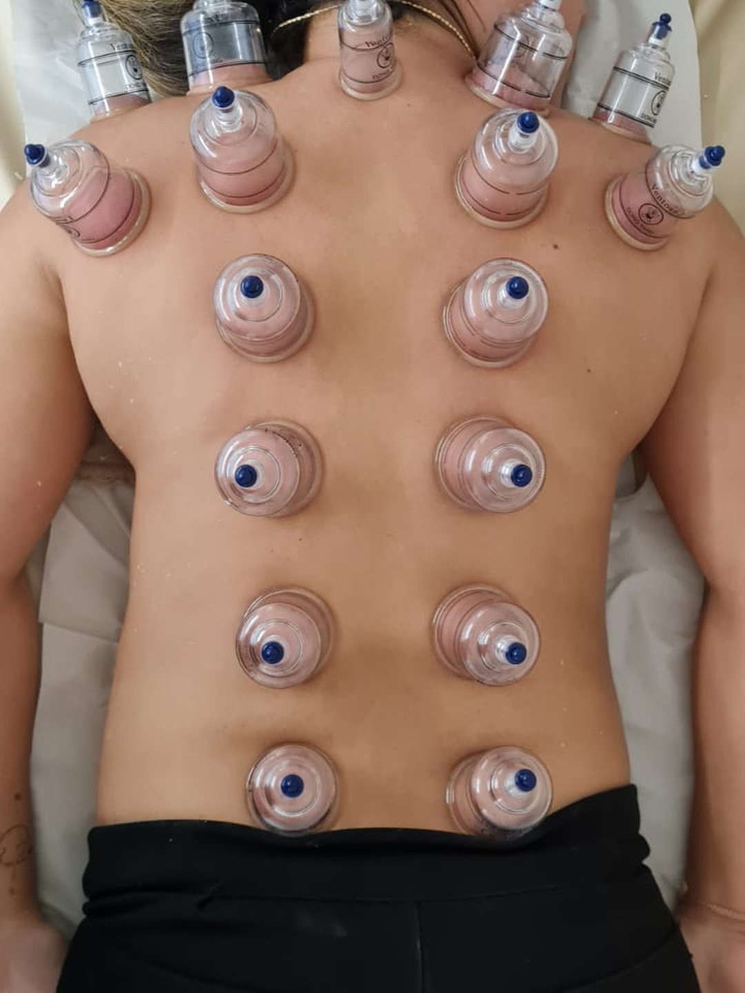 Ventosaterapia com Vela Aromática
