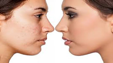 Tratamento de acne e oleosidade